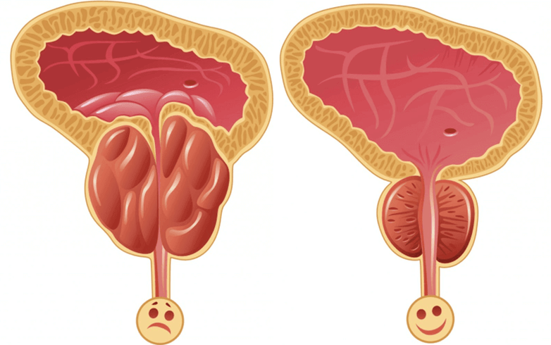 příčiny problémů s potencí u mužů
